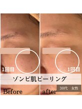 パルティノ 高崎店/ゾンビ肌ピーリング