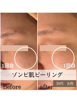 パルティノ 高崎店/ゾンビ肌ピーリング