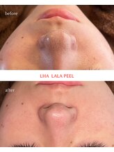 サンク(cinq)/ララピール×毛穴洗浄