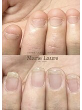 マリーロール 天王寺店(Marie Laure)/自爪育成/深爪矯正/ネイルケア