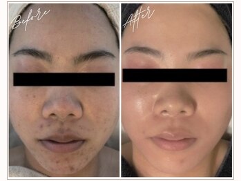 ミューベル(MYubelle)/韓国肌管理 PHA水光ピーリング