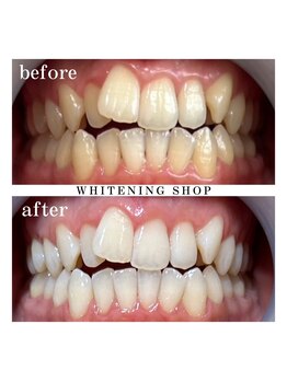 ホワイトニングショップ 上田店/お色の気になる所ご相談ください