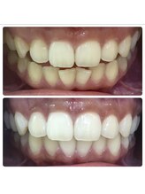 ラブホワイトニング 池袋店(LOVEホワイトニング)/ホワイトニング/ホワイトニング