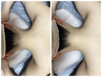 ルルトウキョウ 池袋店(LULU.tokyo)/うなじ脱毛