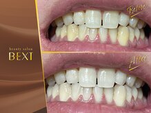 ベクスト(BEXT)/セルフホワイトニング