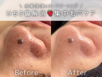 フェイシャルヴィム(FACIAL VIM)/毛穴洗浄とハーブの掛け合わせ