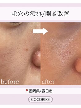 ココリール/クリスティーナ×光フェイシャル