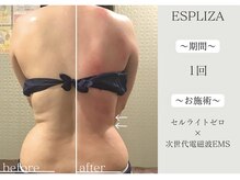 エスプライザ 横浜駅前店/一回で脂肪を撃退！！【痩身】