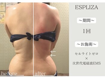 エスプライザ 横浜駅前店/一回で脂肪を撃退!!【痩身】