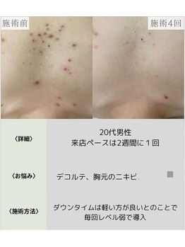 サロンエヌ 久留米店(Salon N)/デコルテ美人に◎
