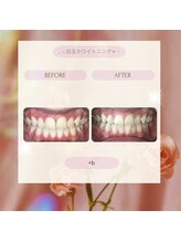 プラスビーセルフ(+b self)/ホワイトニングビフォーアフター