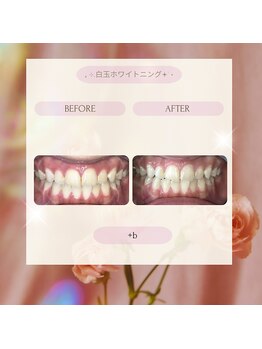 プラスビーセルフ(+b self)/ホワイトニングビフォーアフター