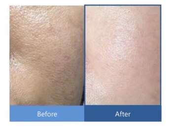 シアビューティーサロン(Cia)/毛穴・ざらつき改善 