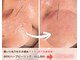 アクシア ビューティー サロン(AXSIA)の写真/乾燥と毛穴開きをケアして美肌へ。優しく整えるREVIハーブピーリングで肌荒れケア★