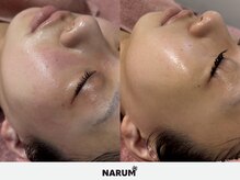 ナルムフェイシャル 代々木(NARUM facial)/敏感肌 水光ピール