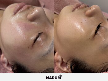 ナルムフェイシャル 代々木(NARUM facial)/敏感肌 水光ピール