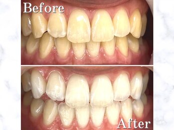 LBSホワイトニング 銀座店/セルフホワイトニングの症例写真