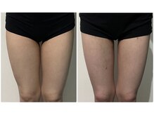 OBS/太もも集中痩身