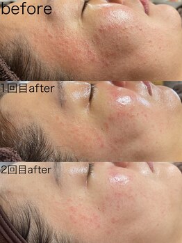 アトレ アンド ミューズ(Attrait×Muse)/LAMI PEEL