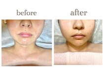 当店一番人気の小顔エステでリフトアップ！