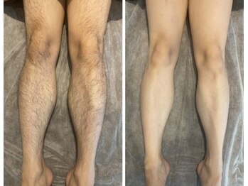 サボ 福岡(SAVO)/足脱毛6回☆