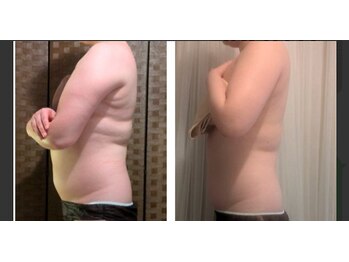 ポノ(pono)/背中＆お腹のBeforeAfter