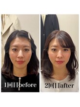 オン鍼灸整体院(ON鍼灸整体院)/美容鍼灸/ビフォーアフター