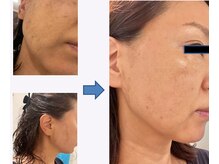 りた/毛穴・くすみ改善