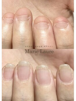 マリーロール 天王寺店(Marie Laure)/自爪育成/深爪矯正/ネイルケア
