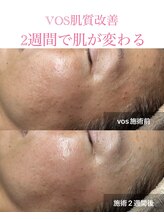 ティアーナ(Tiaana)/肌質改善VOSサロンケア