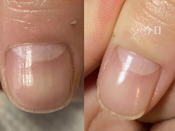 爪を痛めない施術