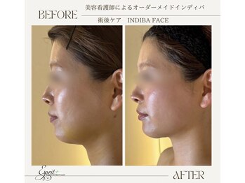 エスプリ(Esprit+)/●術後ケア