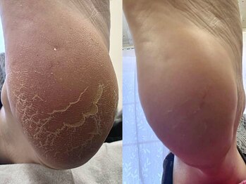 Nail Salon&School~SHINE~の写真/【触り続けたくなる大人女性の滑らかな足裏へ】酷使した足裏は、徹底角質ケアでもっちり癒され美肌に◎