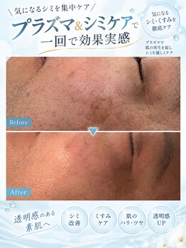ラローゼ トウキョウ(LA ROSEE TOKYO)の写真/プラズマ×シミケアで、気になるシミ・くすみを集中ケア！一回でも変化を実感