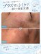 ラローゼ トウキョウ(LA ROSEE TOKYO)の写真/プラズマ×シミケアで、気になるシミ・くすみを集中ケア！一回でも変化を実感