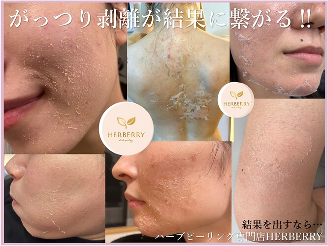 ハーバリー ハーブピーリング 大阪梅田店(HERBERRYハーブピーリング  
