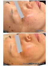 レイール(Reir)/シミにサヨナラ。肌若白玉コース