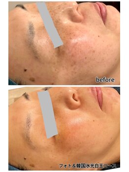 レイール(Reir)/シミにサヨナラ。肌若白玉コース