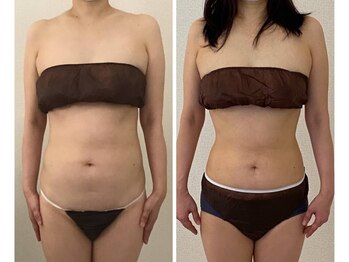 美人バスト 南森町店/バストアップ ◇症例◇