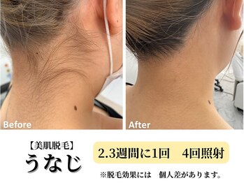 ベルホワイト(Belle White)/【美肌脱毛/うなじ】