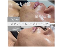 スカイ(sky)の雰囲気（１回で結果出し！赤み剥離ダウンタイムなし◎本気の肌質改善☆）