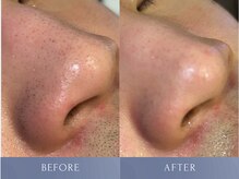 カズキ ハギワラ(Kazuki Hagiwara)/毛穴ケア施術当日ビフォアフ