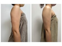 オンケイ(Onkei)/インディバ　二の腕　7回