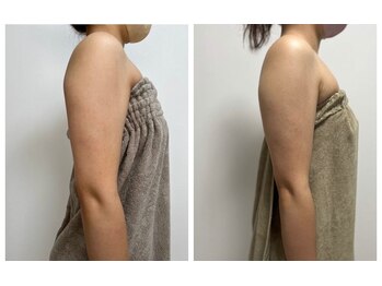 オンケイ(Onkei)/インディバ 二の腕 7回