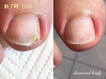 ダイヤモンドボディ/トラブルネイル