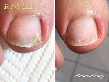 トラブルネイル