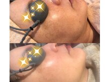 プライベートサロンティアラ 板橋店(TIARA)/ハーブピーリング#志村坂上#板橋