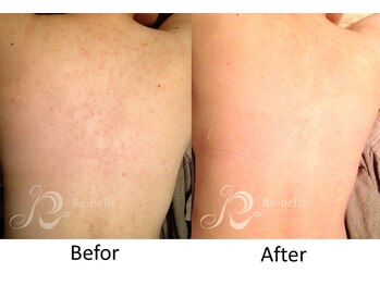 ベルメイク(BELLE MAKE)/リベル☆背中ビフォーアフター