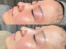 オパール 大阪梅田(op_l)/大阪/毛穴洗浄/フェイスワックス