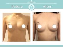 美人バスト 千早店/バストアップ◇育乳症例◇